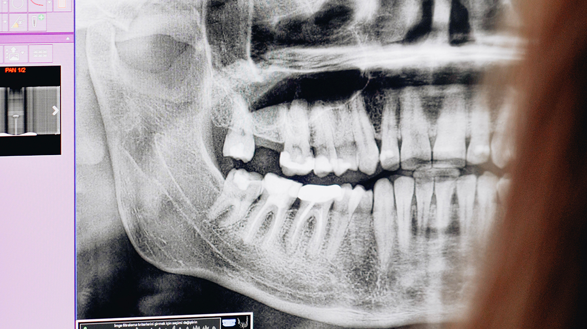 radiología dental en Illescas