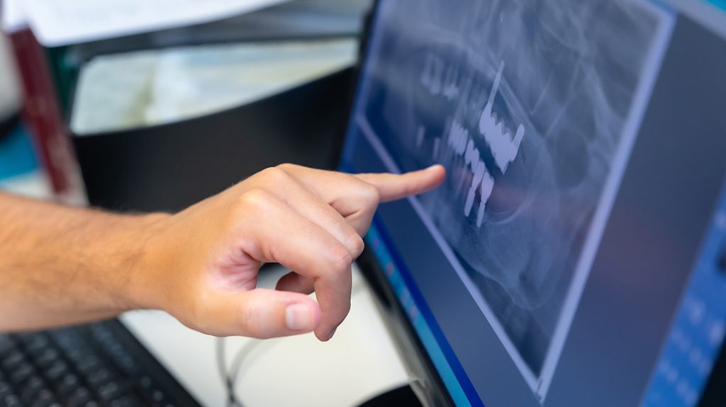 Implantes dentales por dentistas en Illescas