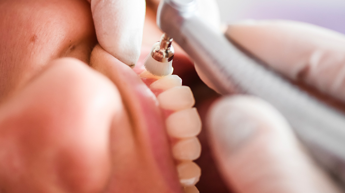 Revisión dental Illescas