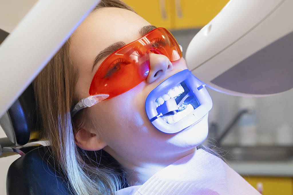 blanqueamiento dental illescas