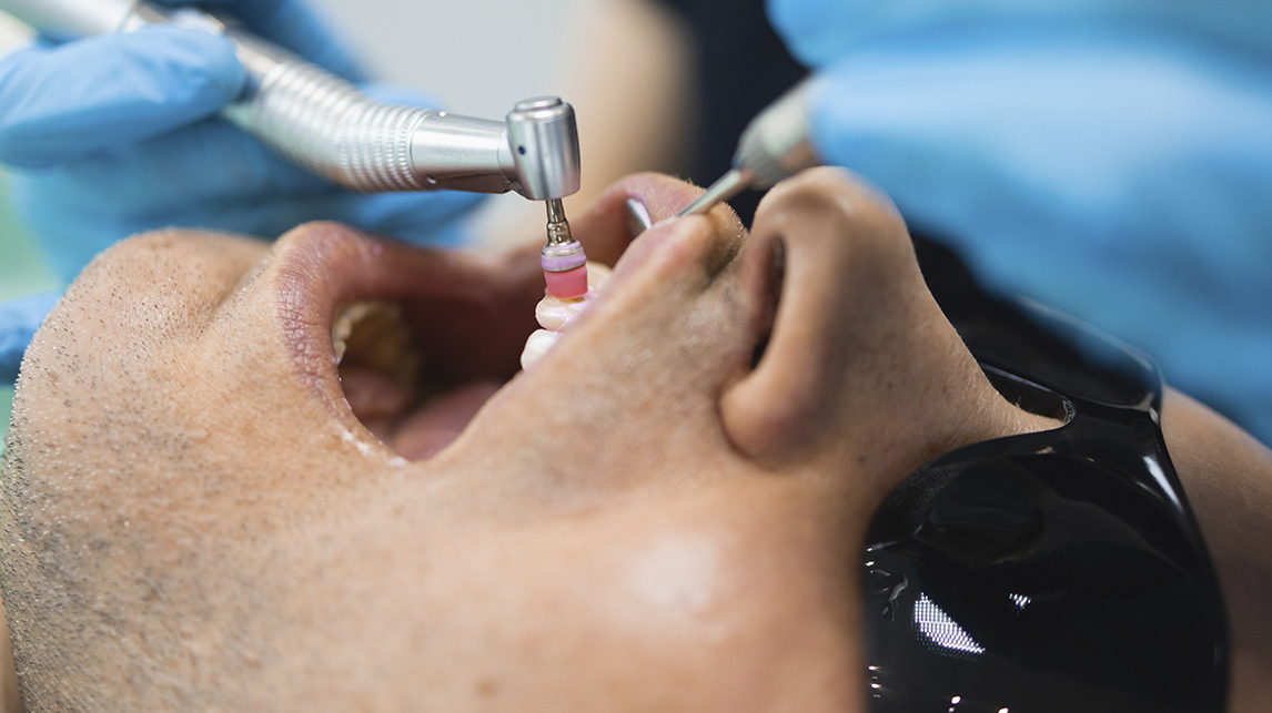 Limpieza dental en Illescas