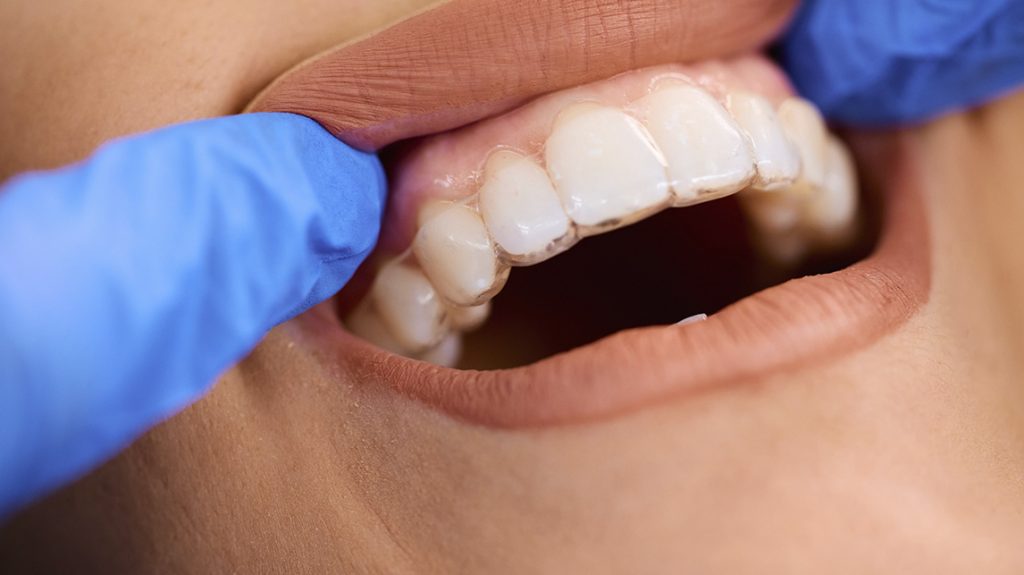 Ortodoncia invisible en Illescas