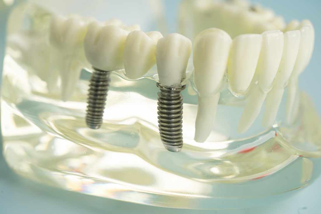 Implantes dentales para mayores en Illescas