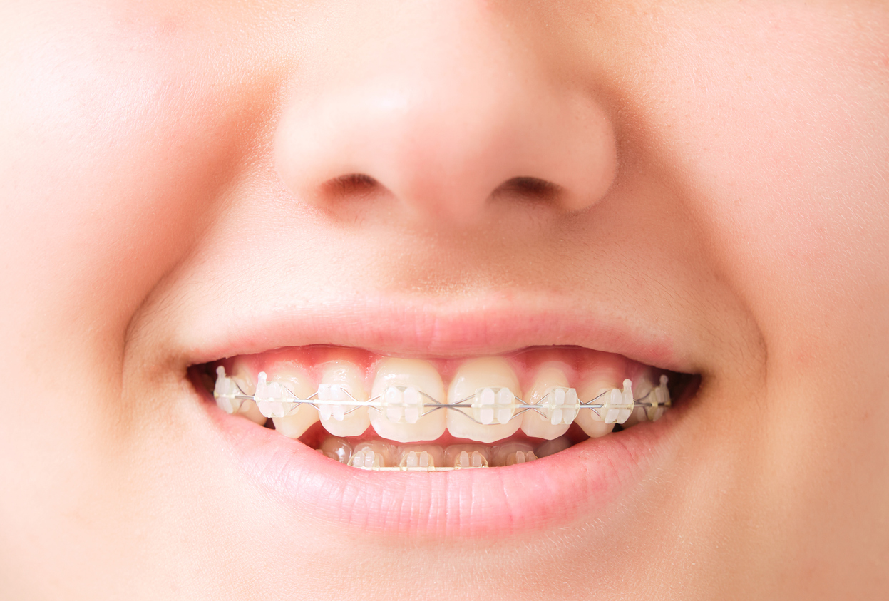 Brackets estéticos en Illescas