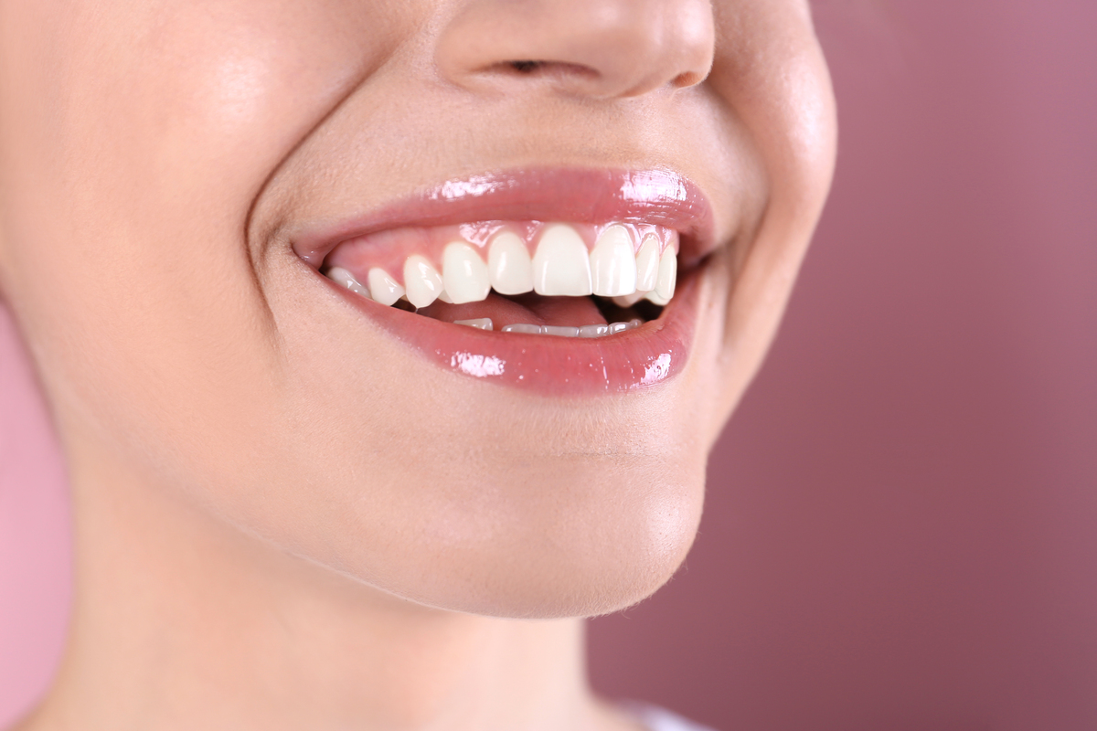 carillas dentales Illescas
