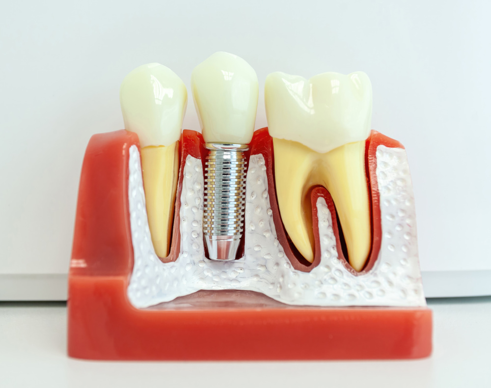 cuánto duran los implantes dentales Illescas