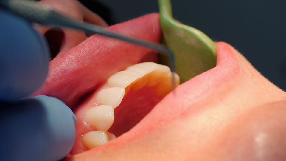Periodontitis en Illescas